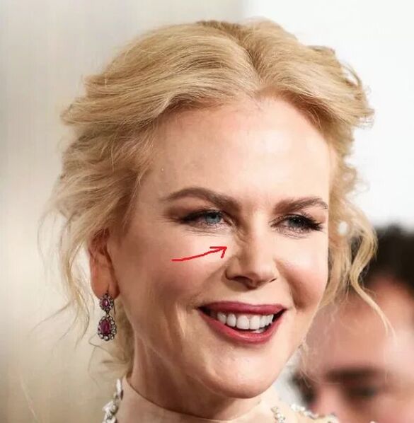 Alternatif kepada Botox